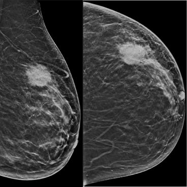 AOSBI - Asian Oceanian Society of Breaast Imaging - Image